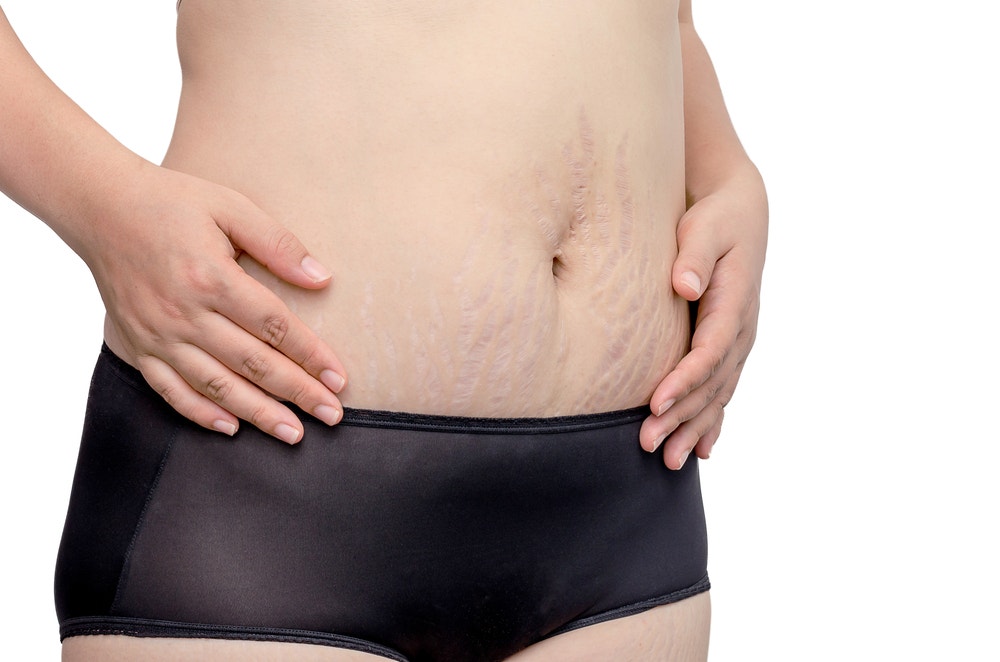 Why Do We Get Stretch Marks? | Theraderm® Clinical Skin Care