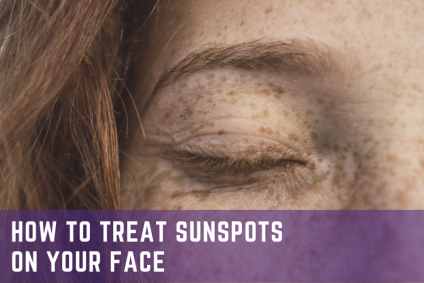 How to Treat Sunspots on Your Face